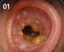 Ear discharge and chronic ear disease patient education visual