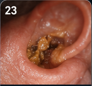 Earwax and ear blockage patient education visual