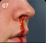Nosebleed patient education visual
