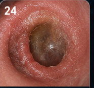 Swimmer's ear and otomycosis patient education visual