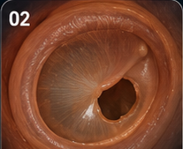 Tympanic membrane perforation patient education visual